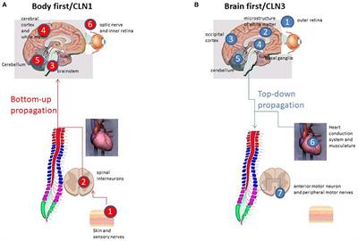 Top-down and bottom-up propagation of disease in the neuronal ceroid lipofuscinoses